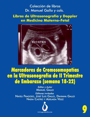 Marcadores Cromosomopatías en la Ultrasonografia de II Trimestre de Embarazo (Semana 18-22)