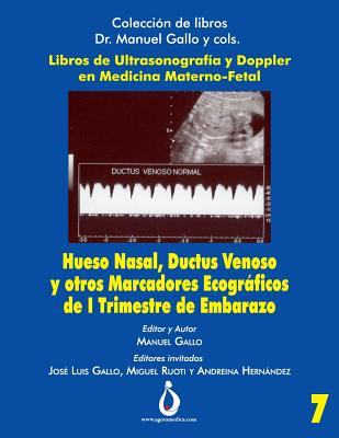 Hueso Nasal, Ductus Venoso y otros marcadores ecográficos de I trimestre de Embarazo